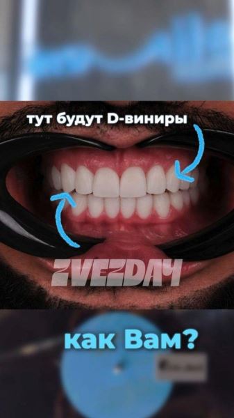 Улыбка на миллион: Киркоров вставил себе бриллианты в зубы (5 фото + видео)